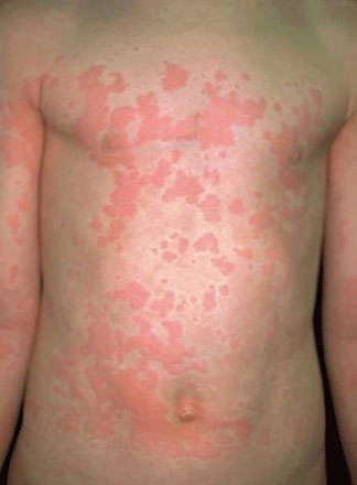 ízületi fájdalom és urticaria